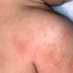 این افراد مستعد سرطان پوست هستند!